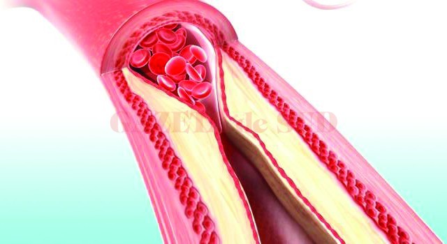 Athersclerosis in artery