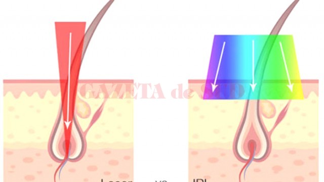 epilare-laser-sau-ip articol ianosi