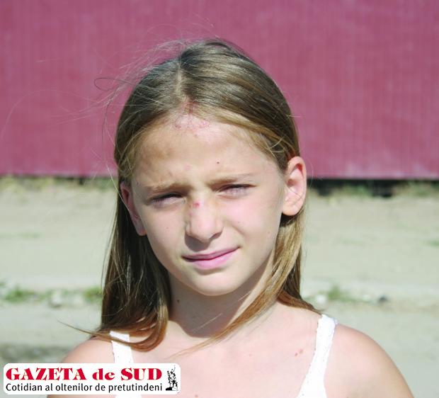 Campioana Diana Dobrin are o eczemă pe frunte