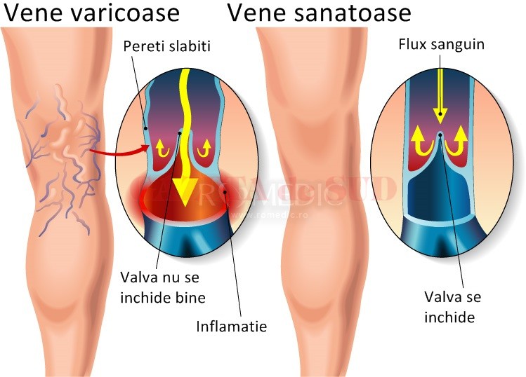 simensiunile din venele varicoase