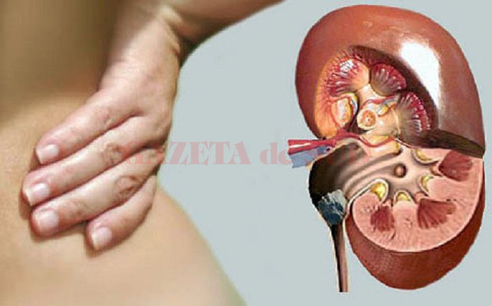 Pietrele la rinichi: simptome, tratament și prevenire | Digi24