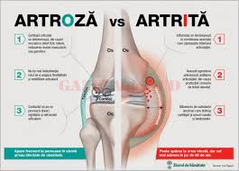 Care este diferenta dintre artroza si artrita