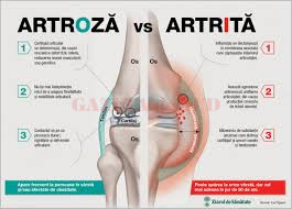 nutriție pentru tratamentul artritei cu artroză