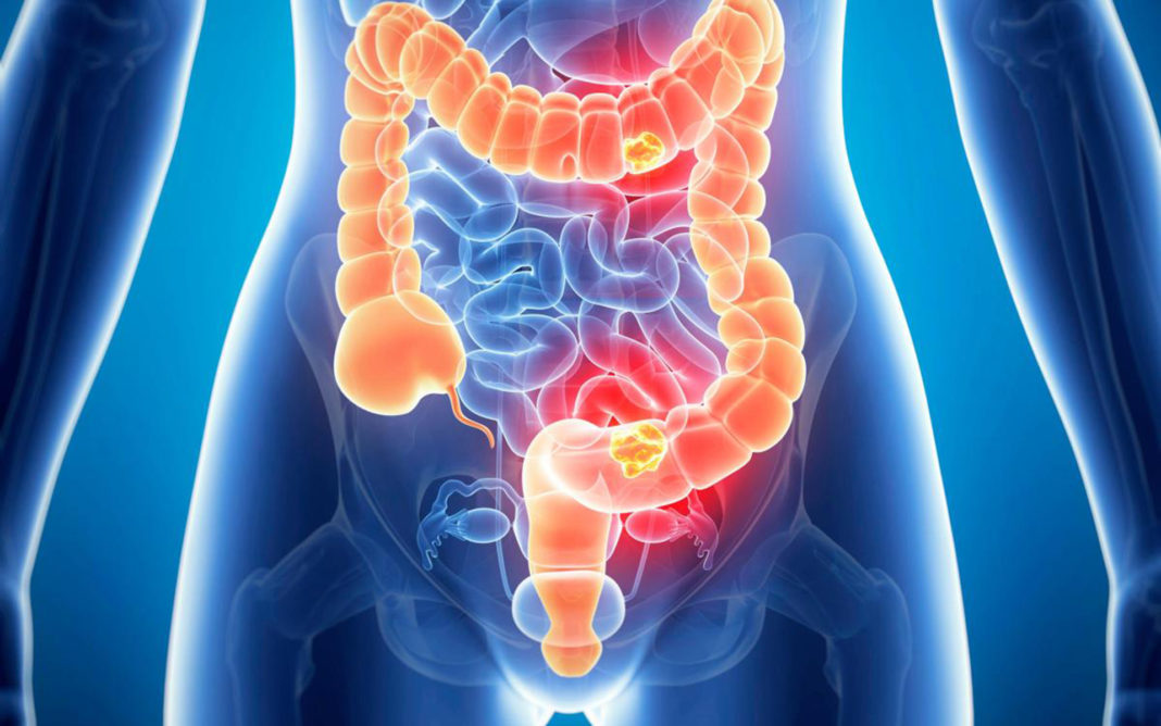 Ce trebuie să ştii despre cancerul la colon