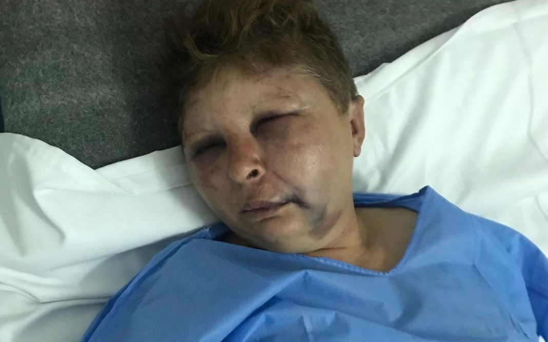 Femeia de 49 ani a ajuns la spital cu contuzii la nivelul feței