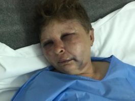 Femeia de 49 ani a ajuns la spital cu contuzii la nivelul feței