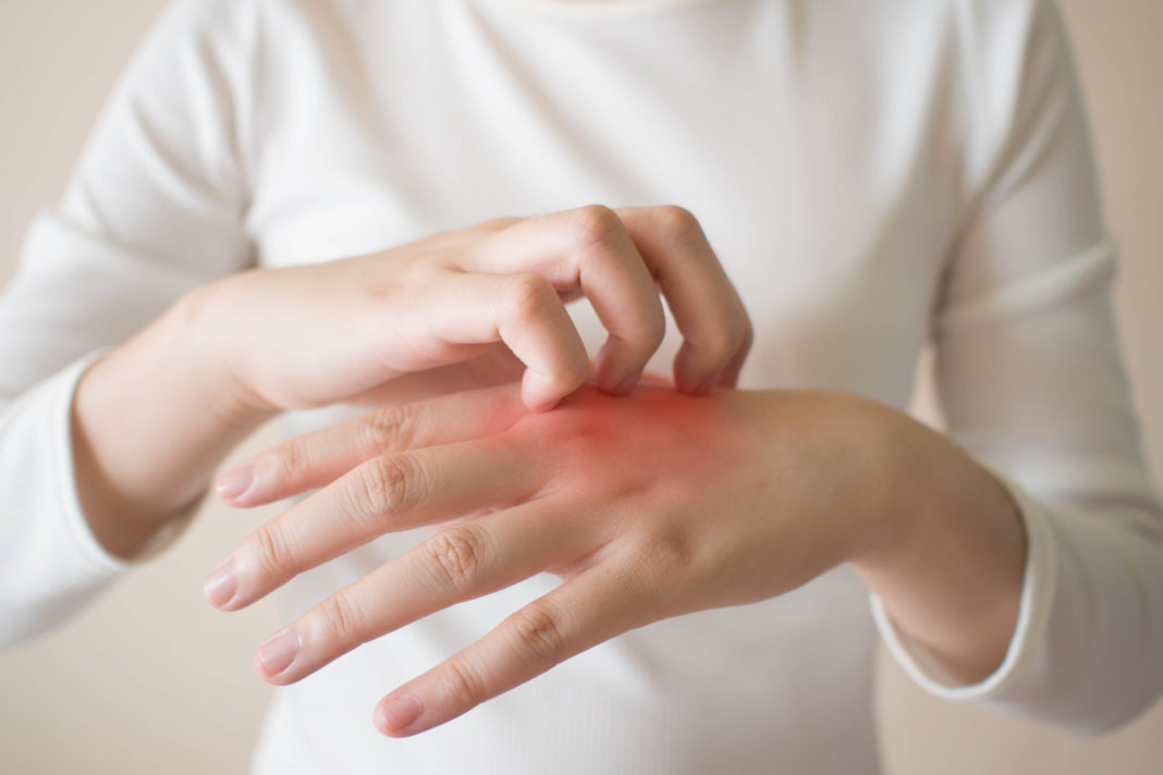 Ce sunt eczemele şi cum le tratăm