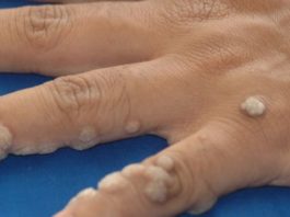Negii sunt mici excrescenţe benigne (noncanceroase) apărute la suprafaţa pielii