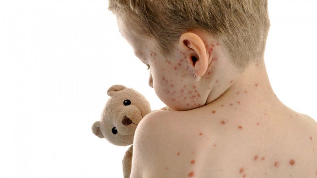 53 de cazuri de varicelă întregistrate în Gorj
