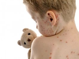 53 de cazuri de varicelă întregistrate în Gorj