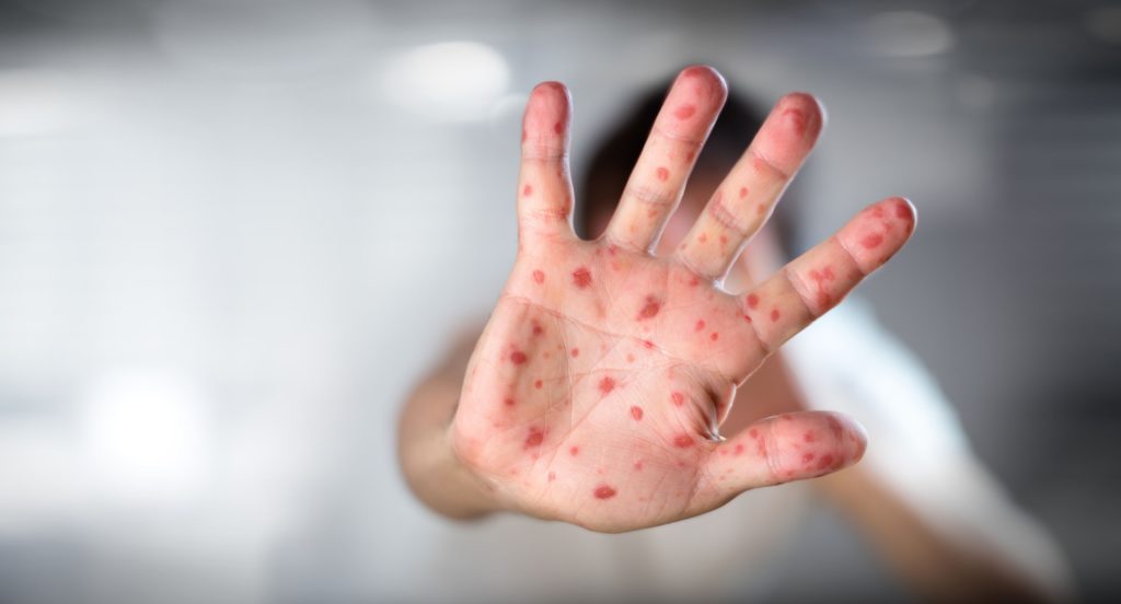 Un băieţel de un an şi jumătate a murit de rujeolă. 791 noi cazuri în ultima săptămână