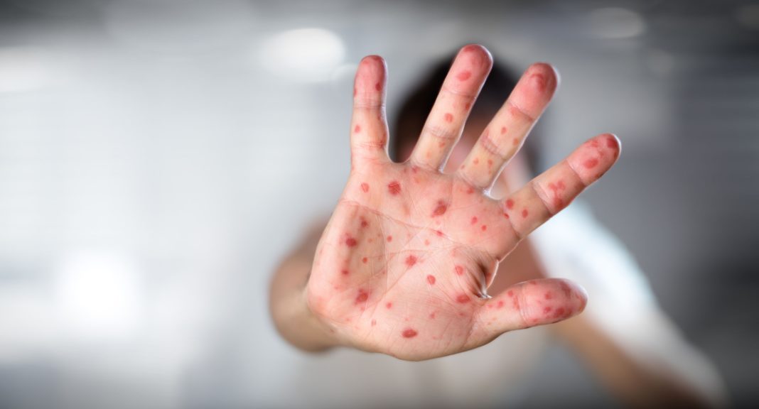 Un băieţel de un an şi jumătate a murit de rujeolă. 791 noi cazuri în ultima săptămână
