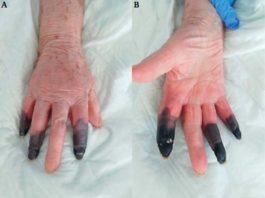 Unei femei din Italia infectată cu Covid i s-au amputat trei degete după ce boala i-a devastat vasele de sânge