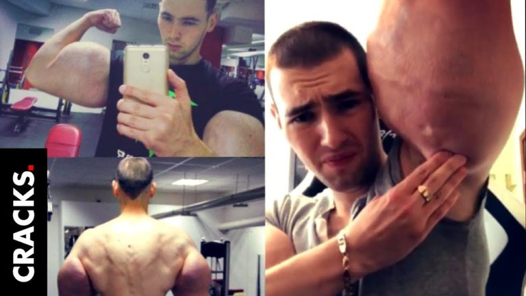 (VIDEO) „Popeye” vrea să-și opereze brațele în care și-a injectat ulei de motor