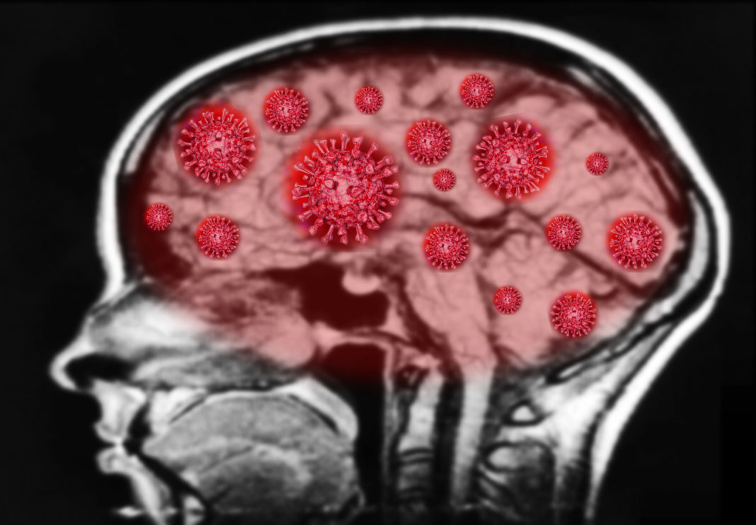 Creierele pacienţilor morţi de Covid, similare cu ale bolnavilor de Parkinson sau Alzheimer