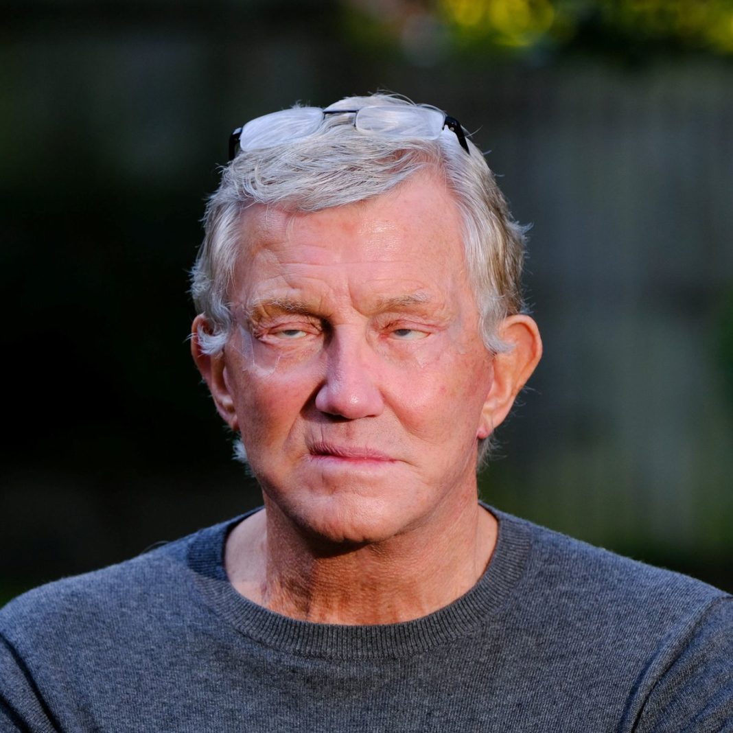 Pete Broadhurst, în vârstă de 79 de ani, vrea să-i avertizeze pe alții despre pericolele chirurgiei plastice