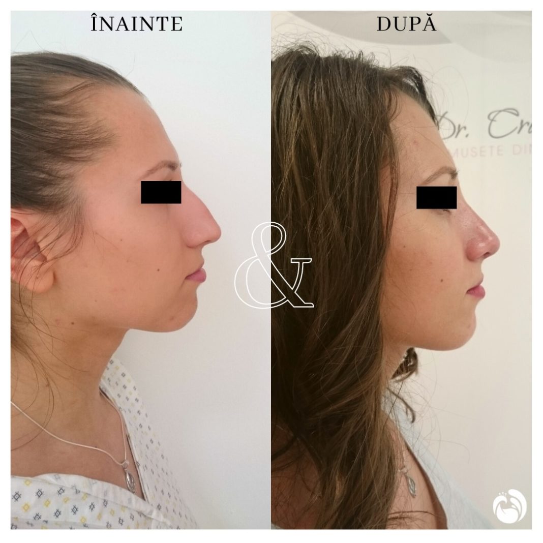 Cristian Niţescu: Dacă înainte de pandemie pe primul loc erau solicitările pentru intervenții chirurgicale la nivelul sânilor și pe locul secund erau rinoplastiile, acum ordinea s-a inversat