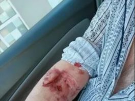 Târgu Jiu: Asistentă medicală, cercetată disciplinar după ce a rănit un pacient cu o foarfecă