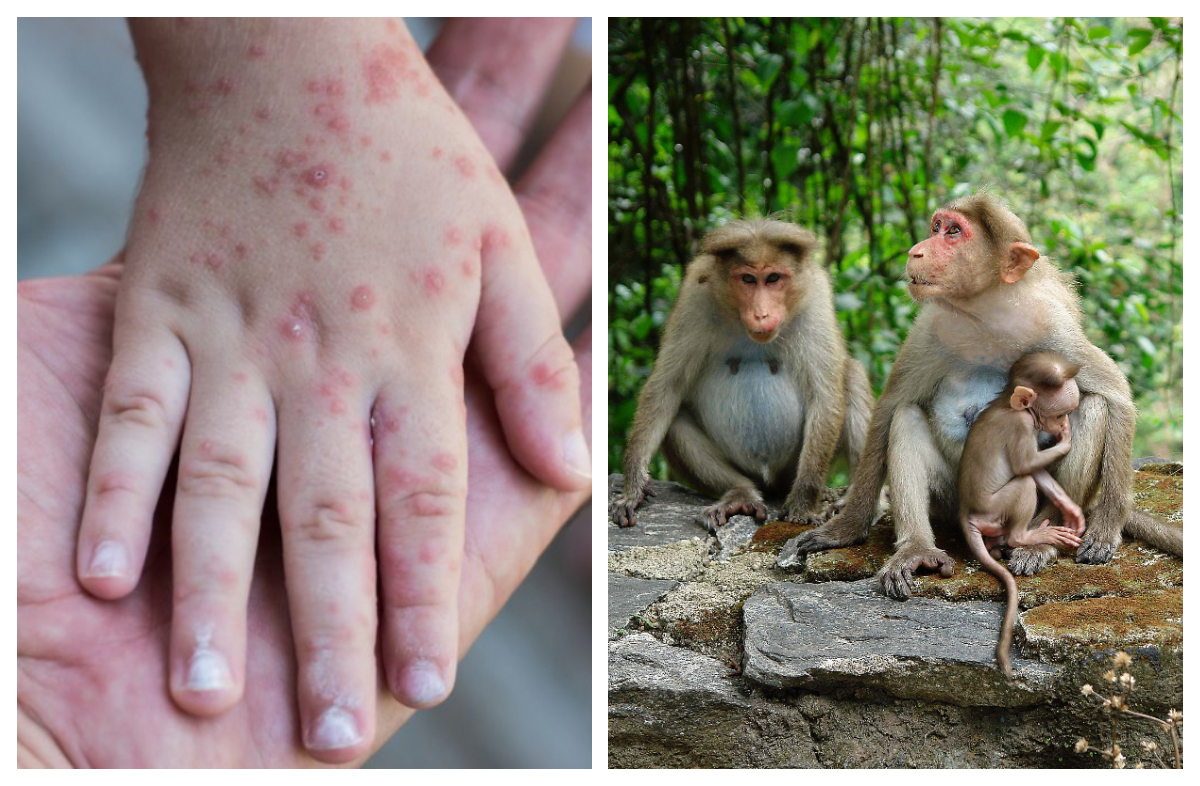 OMS: Focarul de variola maimuței este „controlabil”