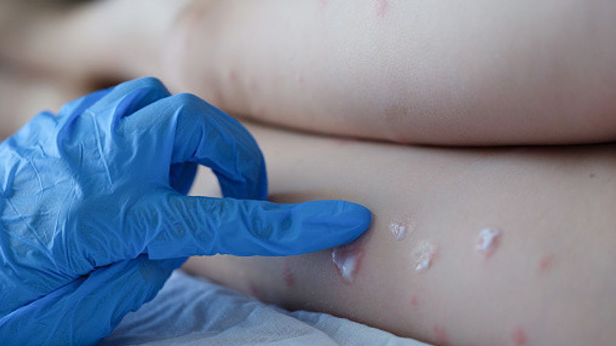 Un nou caz de variola maimuţei în România
