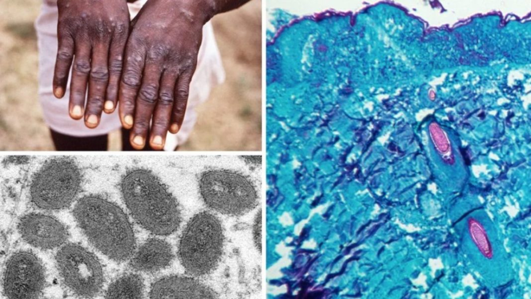 OMS nu are dovezi privind mutaţii ale virusului variolei maimuţei