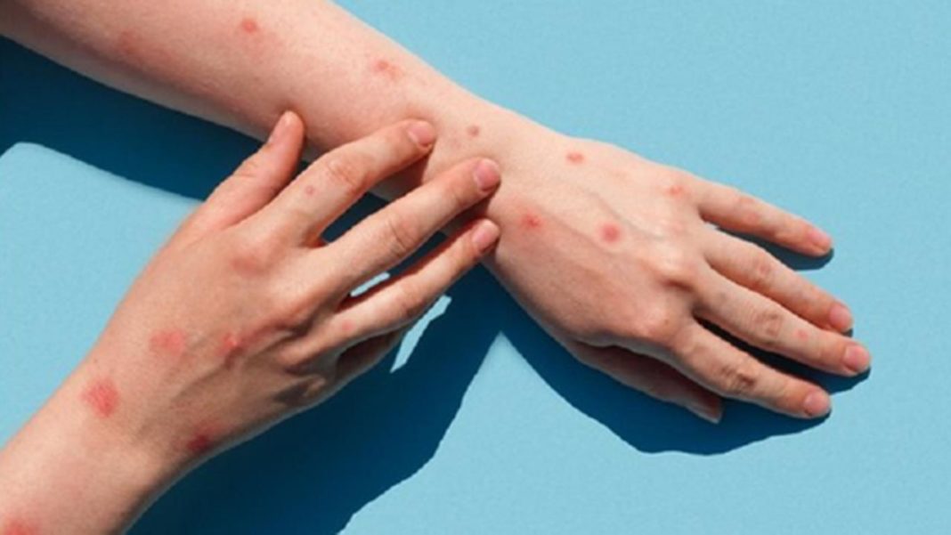 Încă un caz de variola maimuței, diagnosticat în România