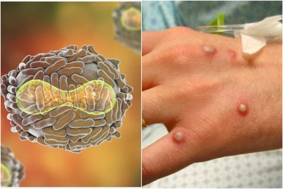 Două noi cazuri de variola maimuței, confirmate în România