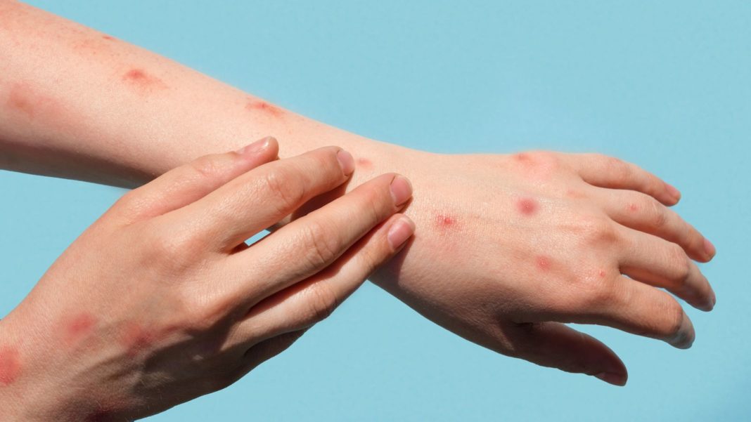 variola maimutei00 OMS cere ca variola maimuţei să fie redenumită mpox