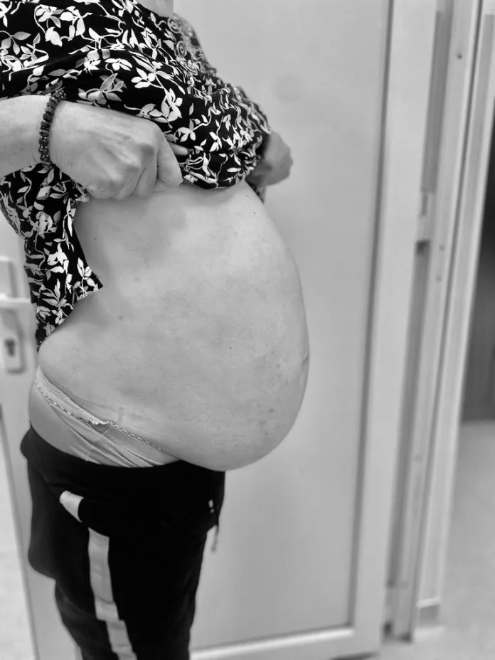 Tumoră gigant de 12 kg si 38 cm/40 cm extirpată la spitalul Militar Craiova