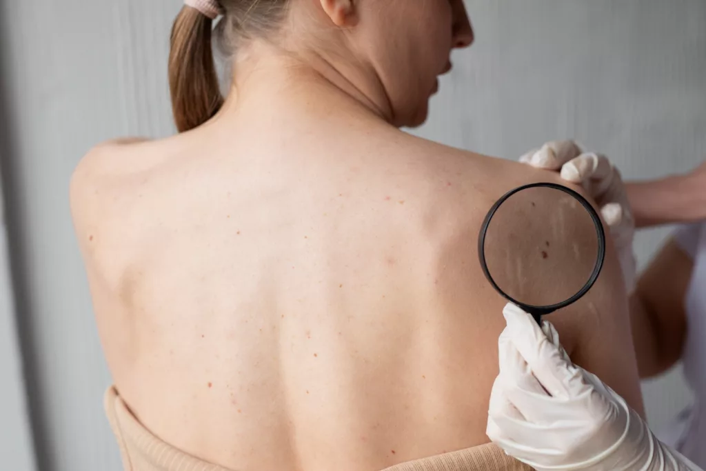 Cancerele de piele, în creştere. Ce semne trădează melanomul