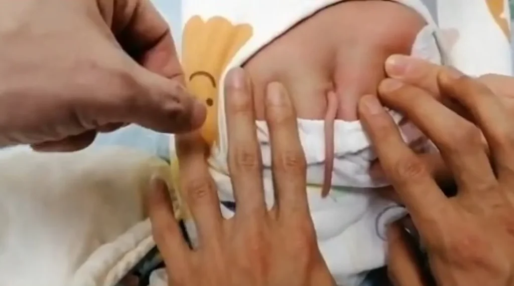 În China s-a născut un bebeluș cu coadă