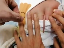 În China s-a născut un bebeluș cu coadă
