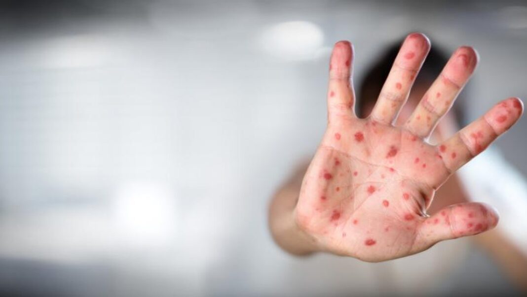 490 de cazuri noi de rujeolă în ultima săptămână