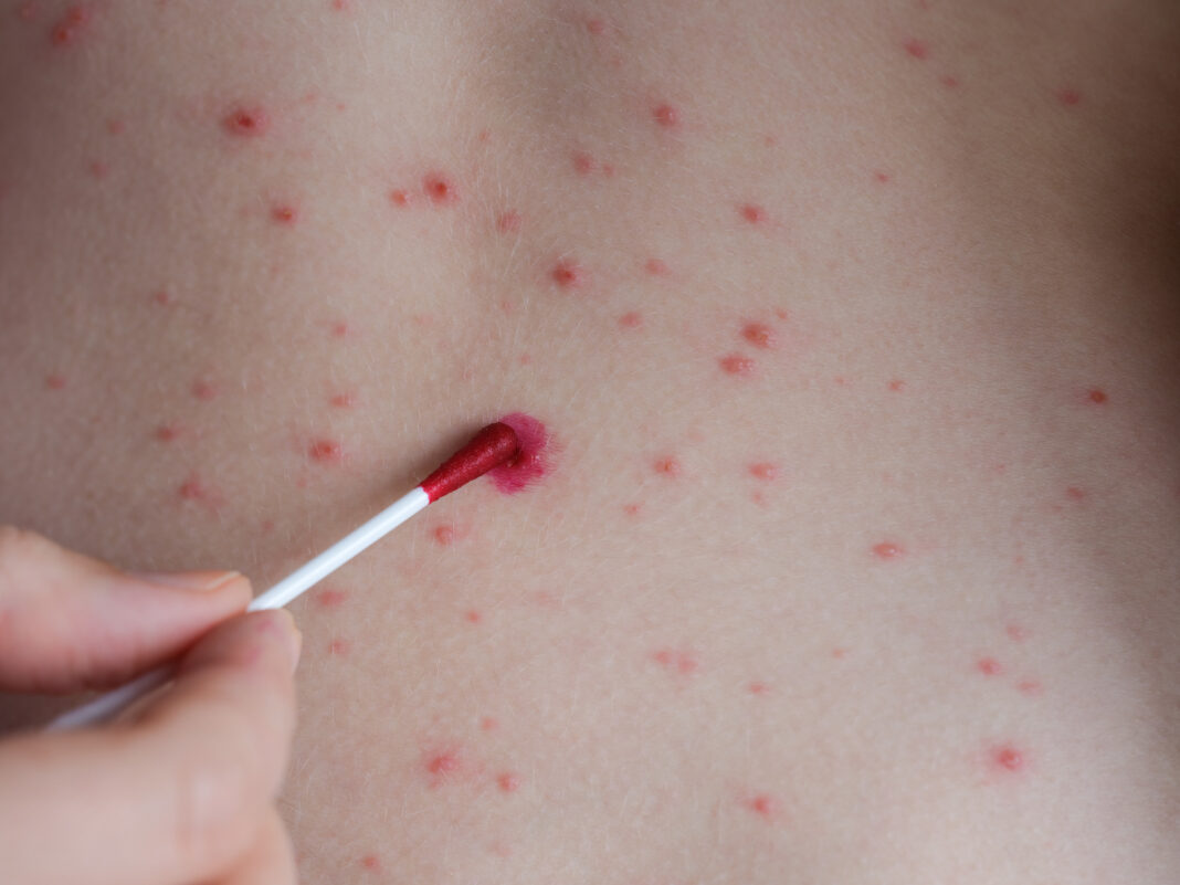 Copil de doi ani, nevaccinat, mort din cauza rujeolei