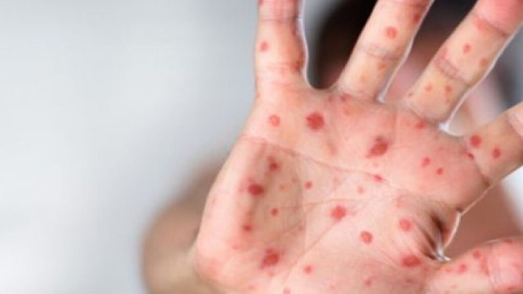OMS: Cazurile de rujeolă au crescut cu peste 200% în UE, cu România în top