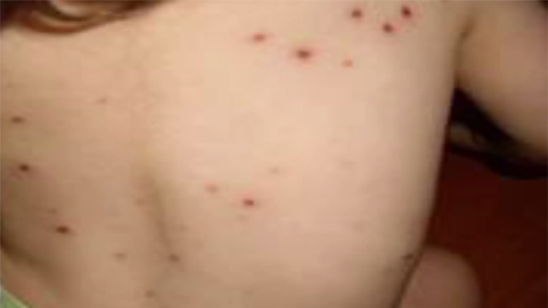 În ultima săptămână, aproape 600 de cazuri noi de rujeolă