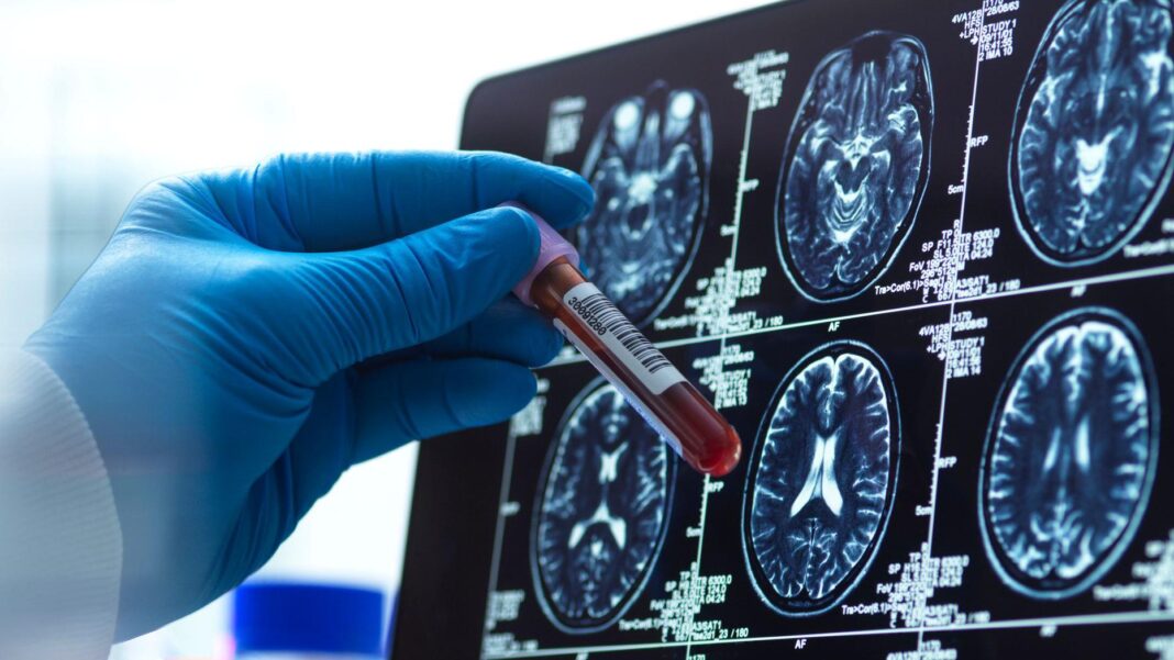 alzheimer Test de sânge pentru boala Alzheimer