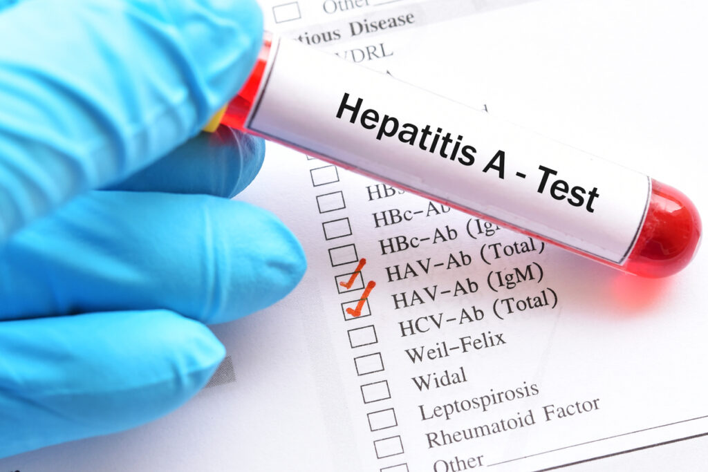 Proba de sânge pentru testul pentru virusul hepatitei A (VHA)