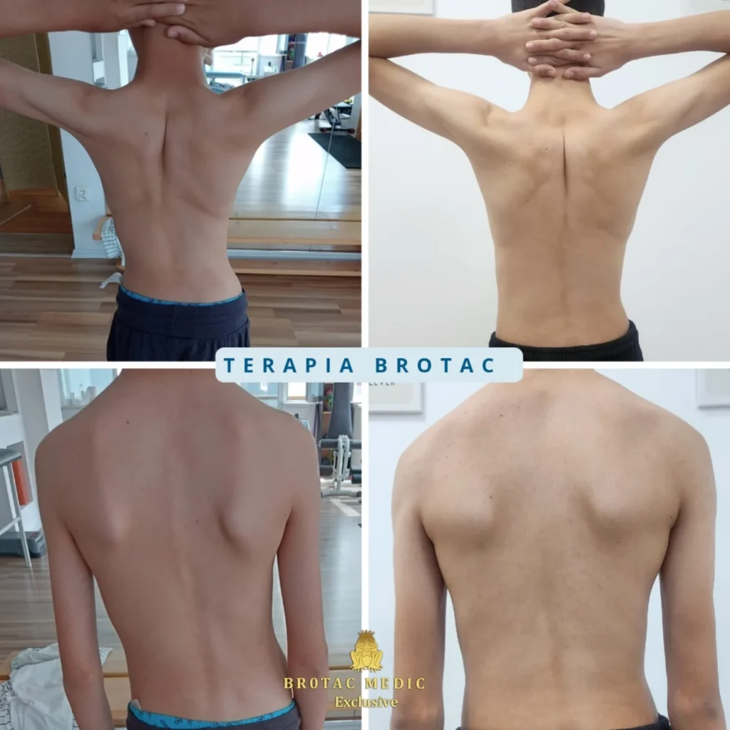 Scolioza la copii: cum poate fi schimbată evoluția prin terapie consecventă. Rezultate după 2 ani