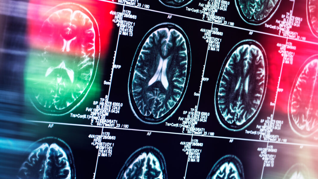 Analiza a inclus peste 20.000 de pacienți