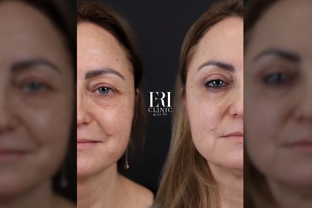 La ce clinică din Craiova poți face blefaroplastie pentru un aspect mai tânăr al zonei ochilor?