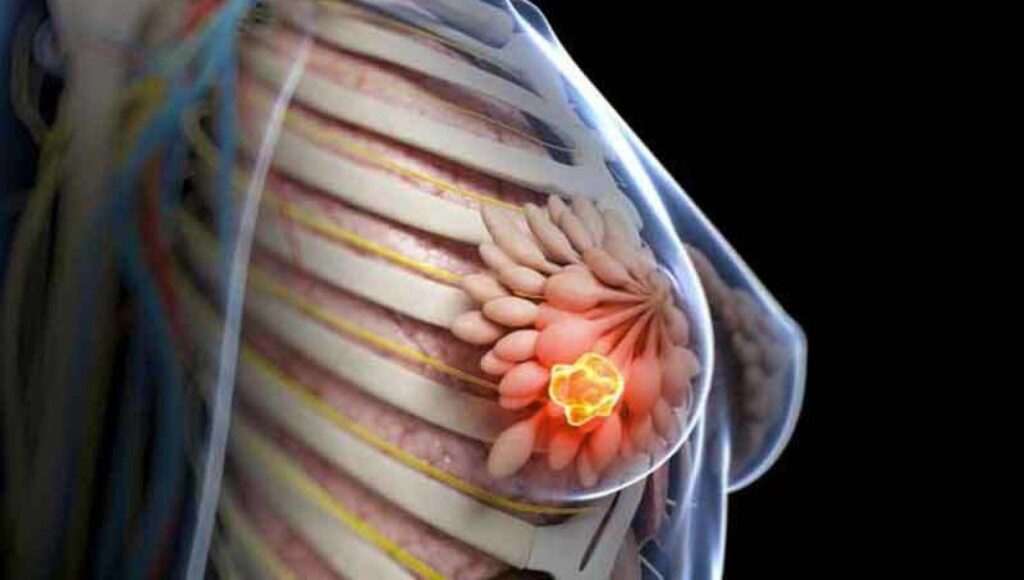Cancerul de sân metastazează conform unui „program precis“