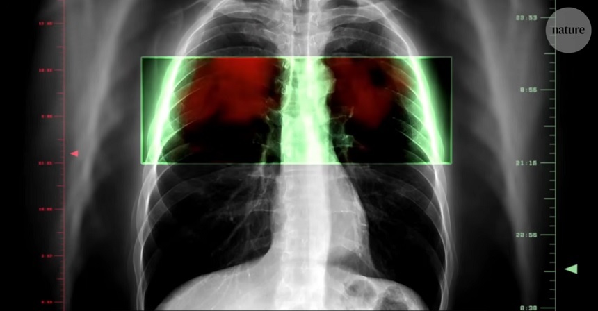 Nature – Ar putea o pastilă să prevină cel mai mortal tip de cancer din lume?