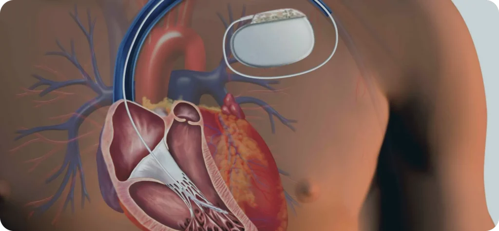 În România sunt implantate anual doar 700 de defibrilatoare cardiace interne. Numărul este la jumătate față de media europeană